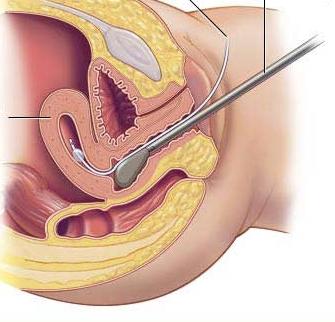 Endometrium โพลีเมอร์: มันคืออะไร? สาเหตุอาการและวิธีการรักษา