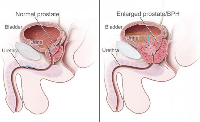 เป็น prostate prostate ไม่